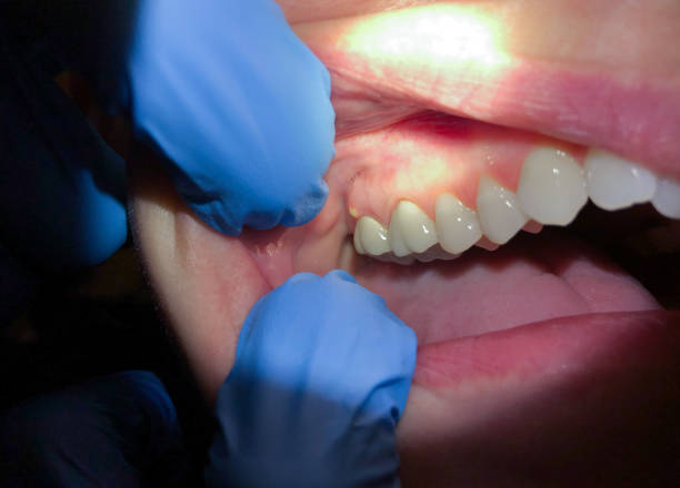 Best Emergency Wisdom Tooth Extraction in Hugo, MN